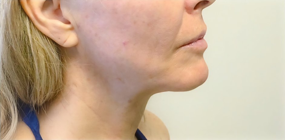 Lipo de papada Depois